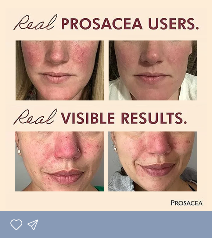 real results on real women prosacea cream