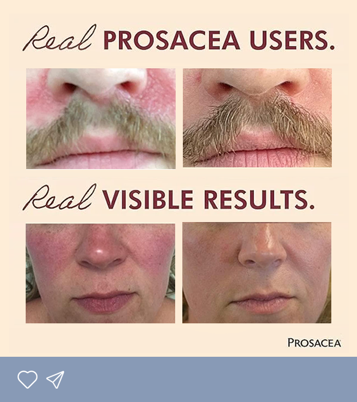 real results on real people rosacea cream